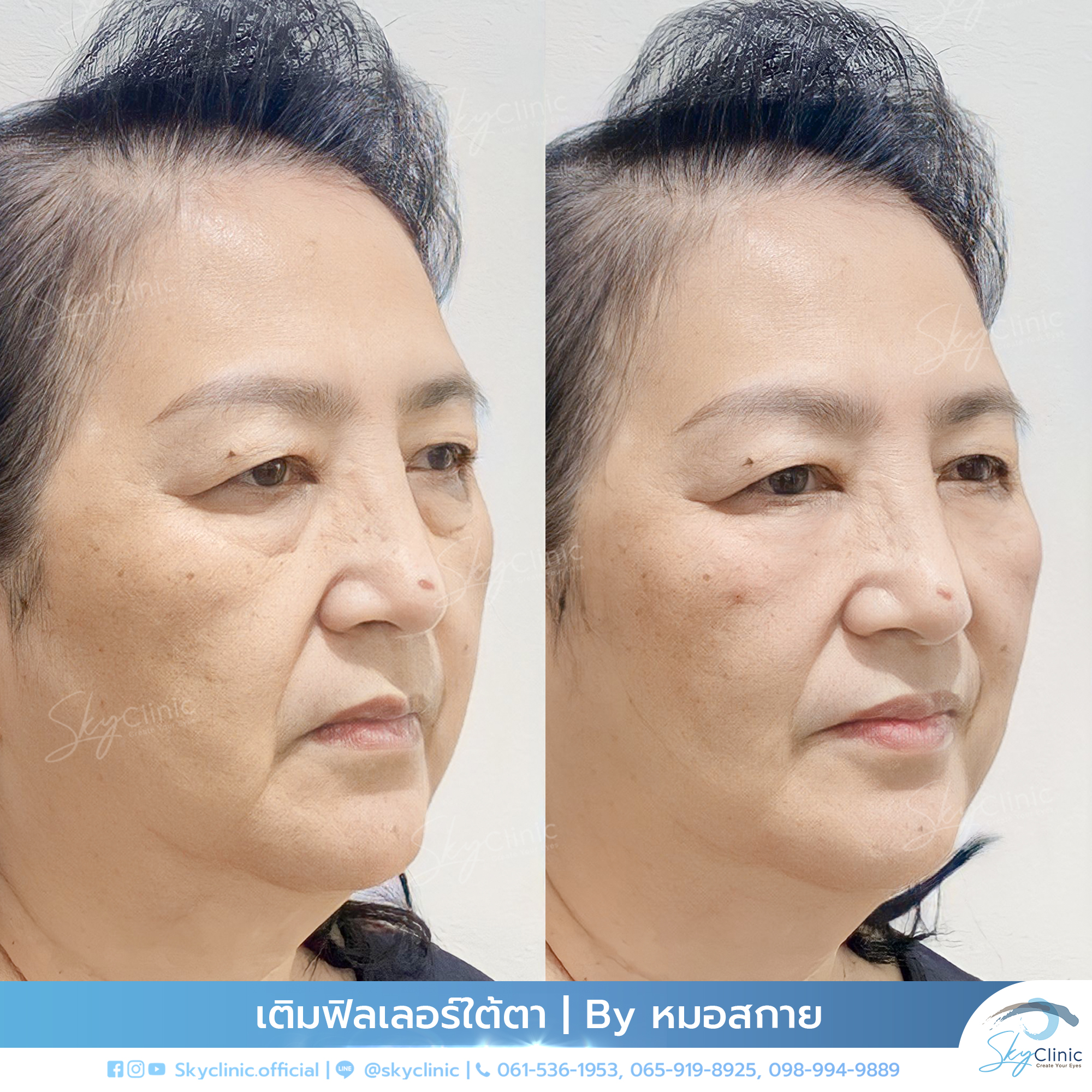 Eye Rejuvenation Using Dermal Fillers