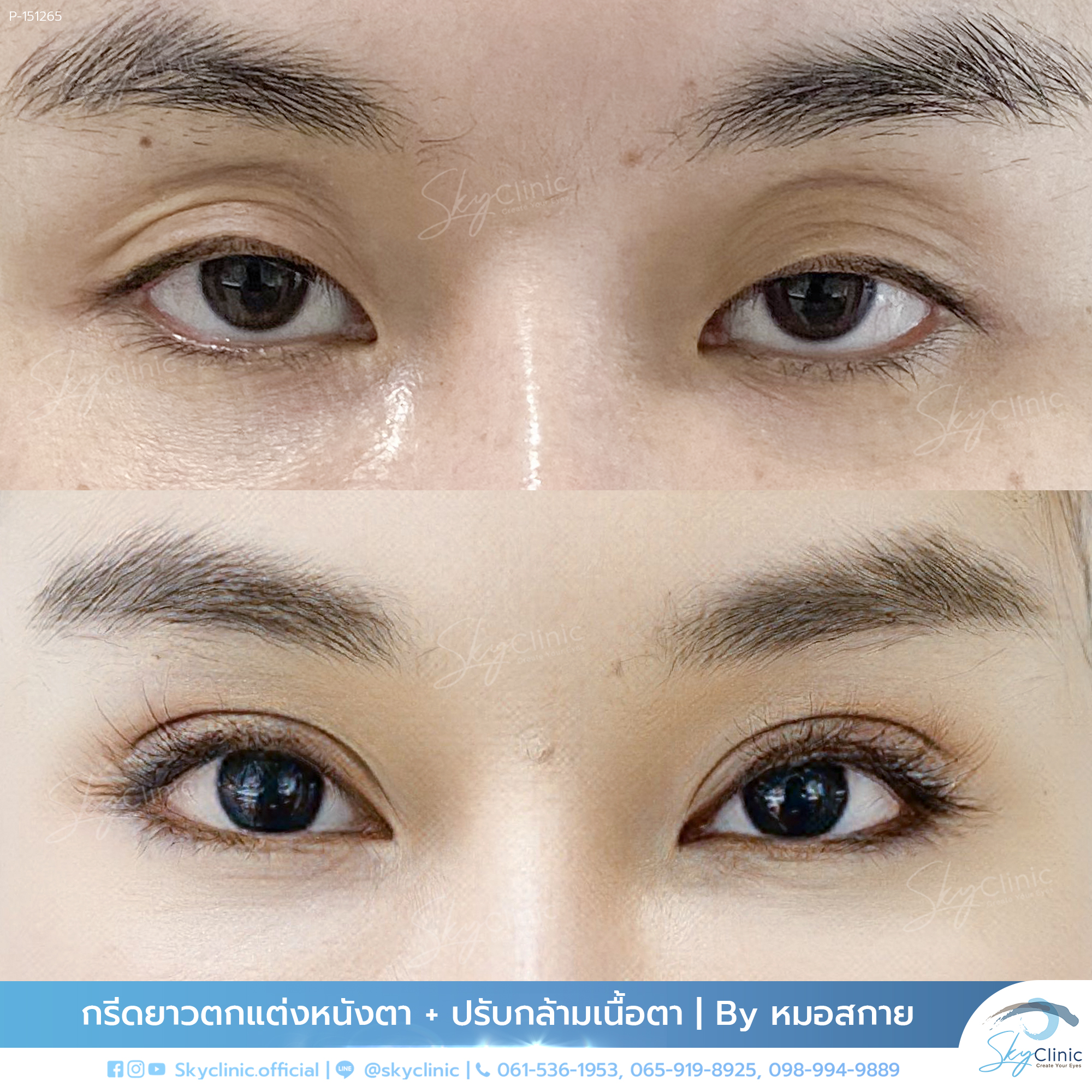 Correction of Ptosis, Deep-Set Eyes, and Hollow Eye Sockets