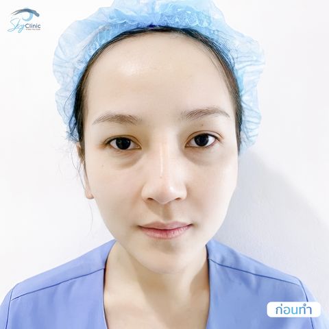 Under-Eye Bag Surgery Case Examples