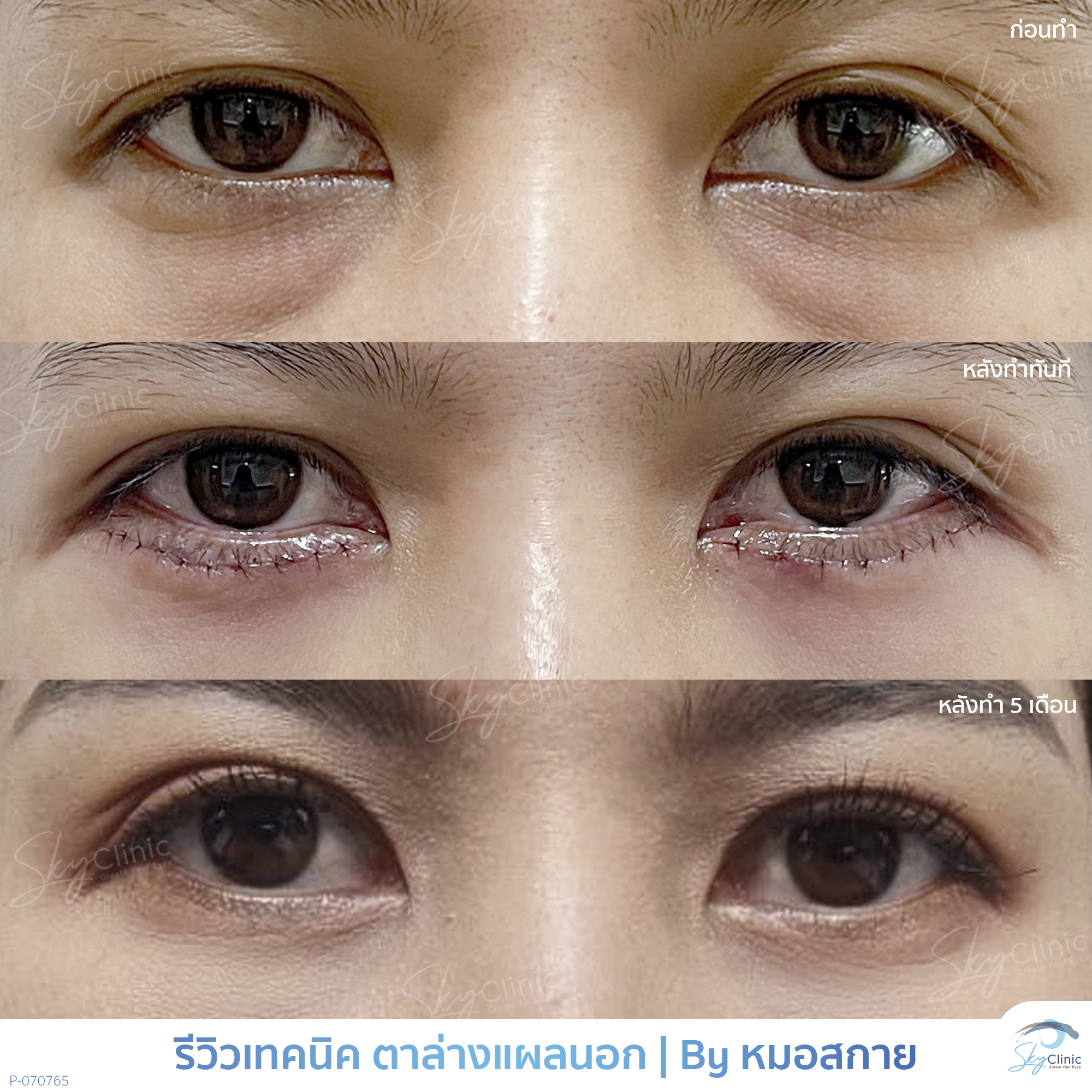 Surgical Treatment of Under-Eye Bags
