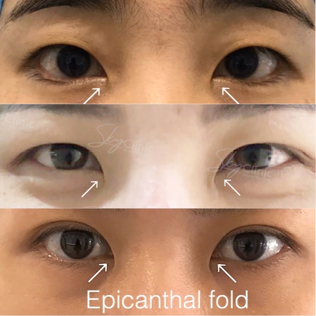 What Is Epicanthoplasty?