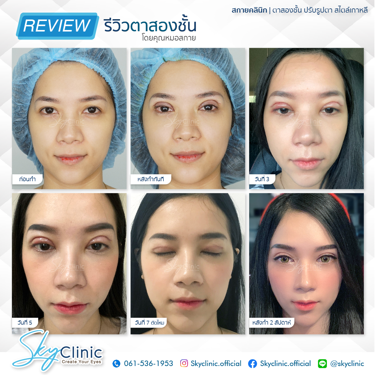 Review of Nong Namfon's experience of getting double eyelid surgery by Dr. Sky