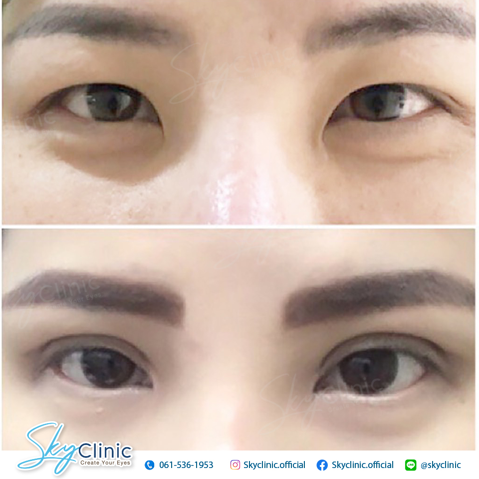 Can Everyone Undergo Epicanthoplasty?