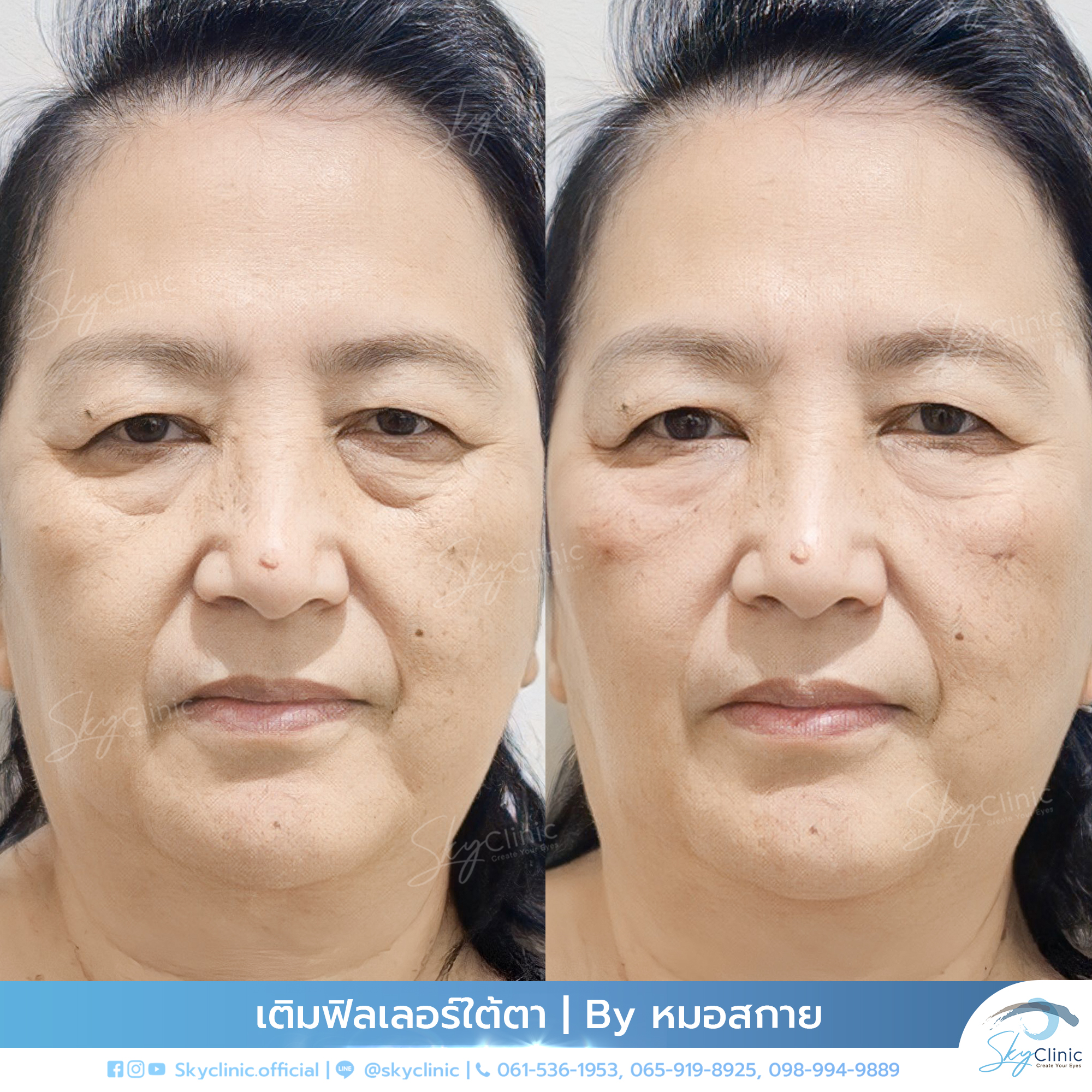 Eye Rejuvenation Using Dermal Fillers