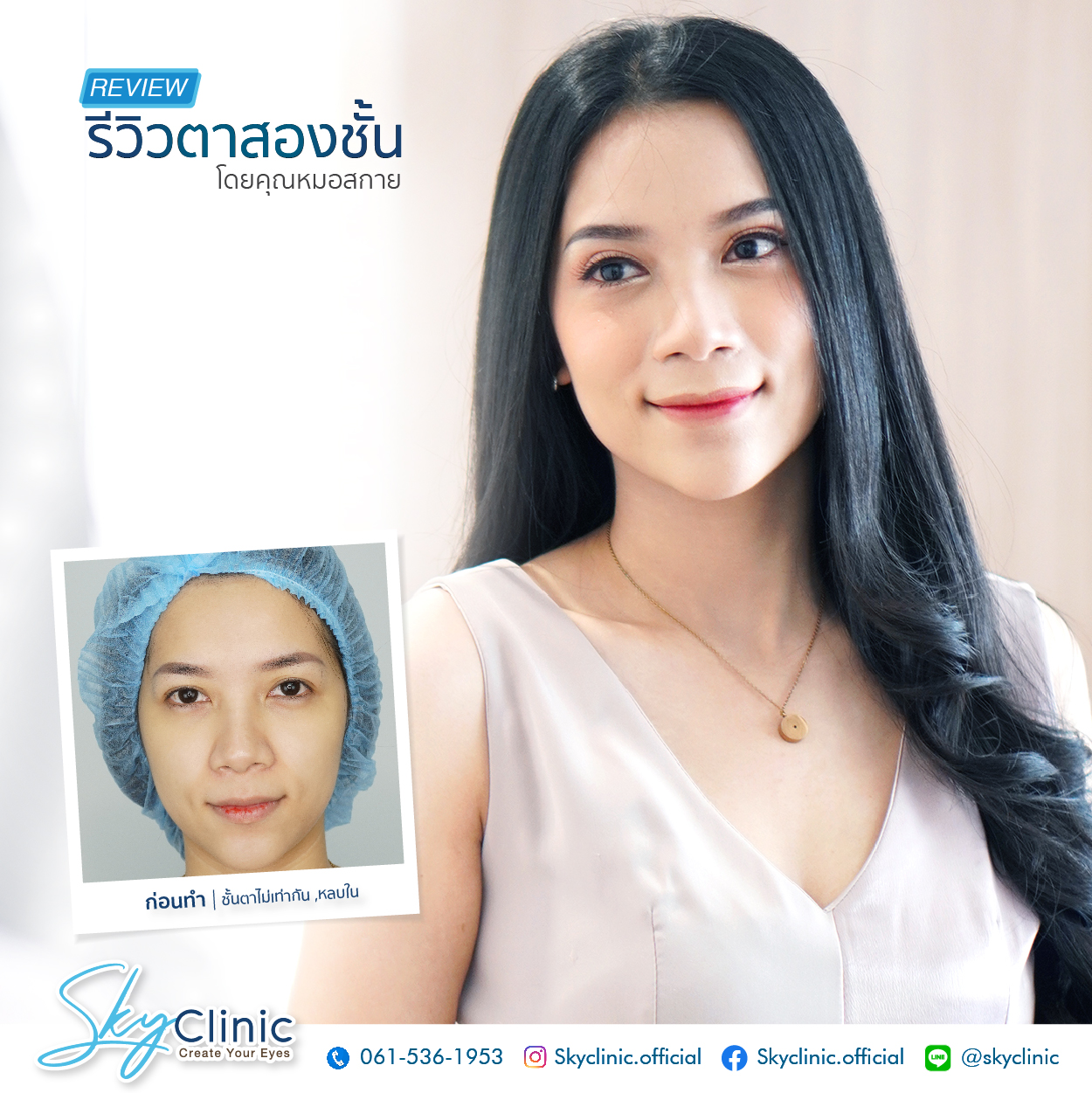 Review of Nong Namfon's experience of getting double eyelid surgery by Dr. Sky