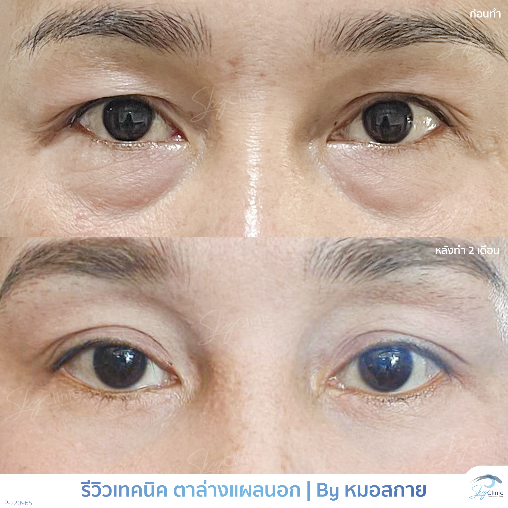 Surgical Treatment of Under-Eye Bags