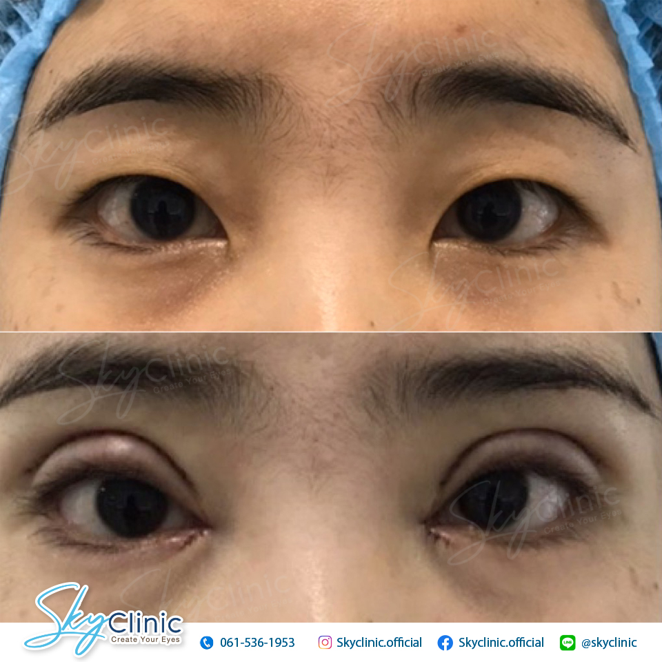 Epicanthoplasty at Sky Clinic