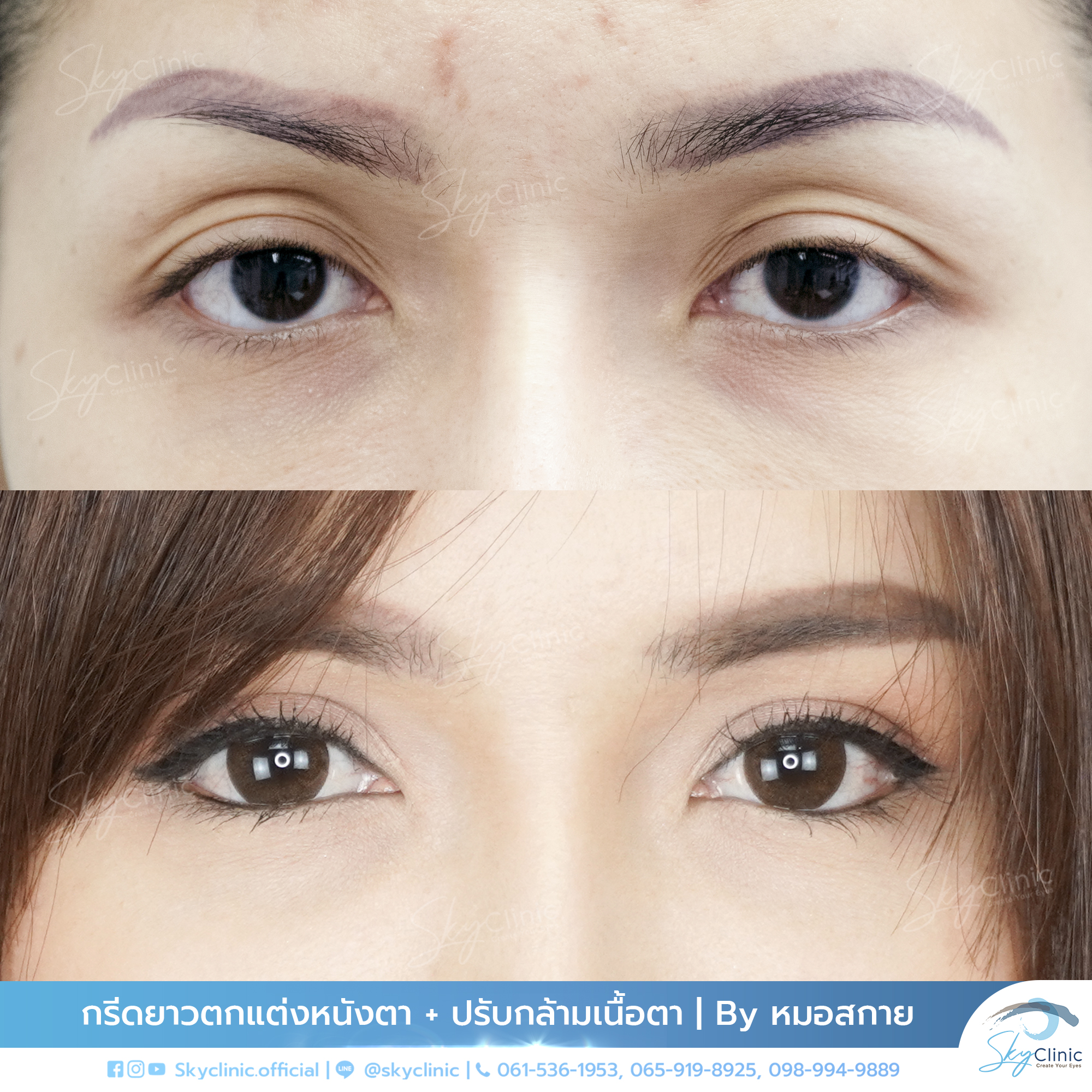 Correction of Ptosis, Deep-Set Eyes, and Hollow Eye Sockets