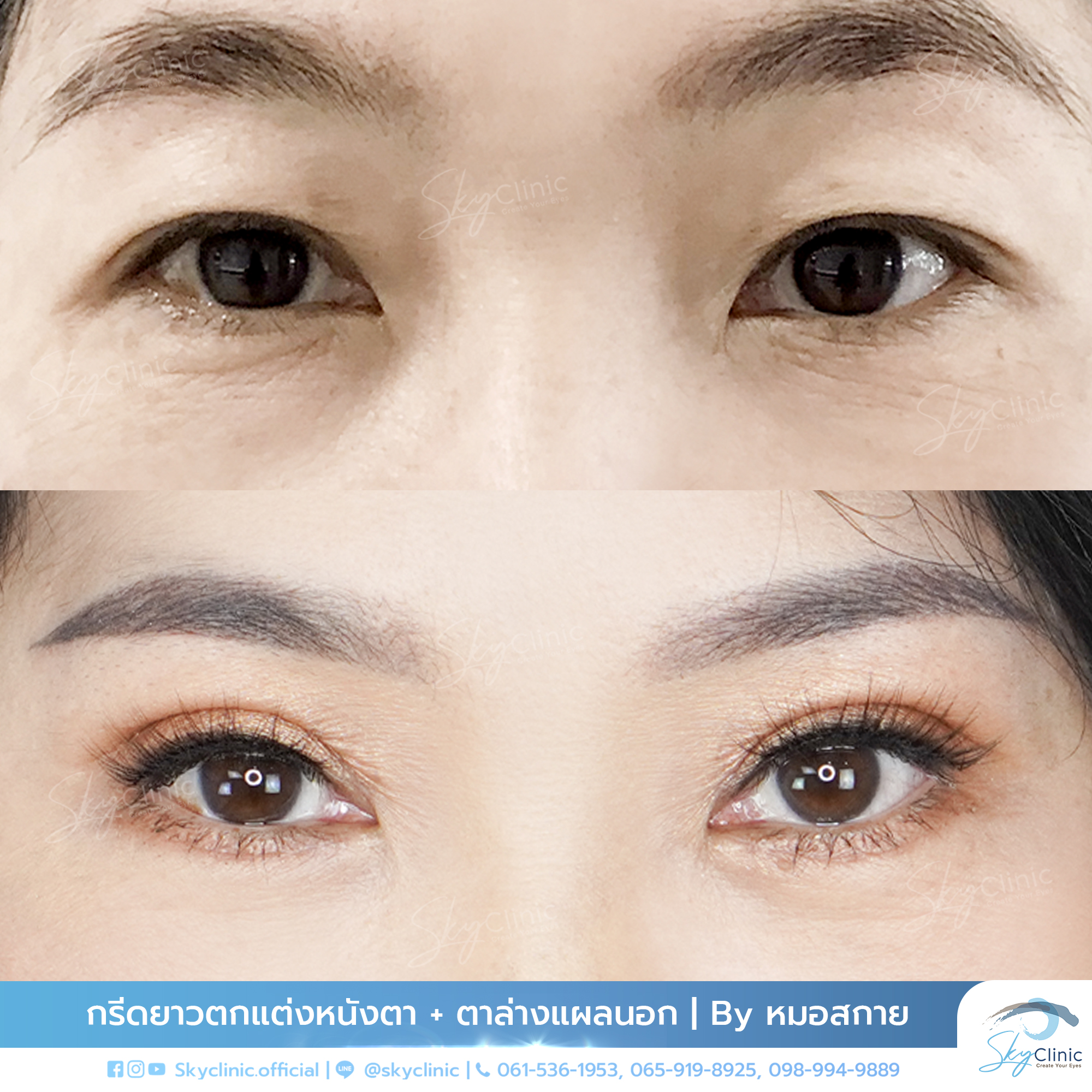 Correction of Drooping Eyelids and Drooping Outer Eye Corners