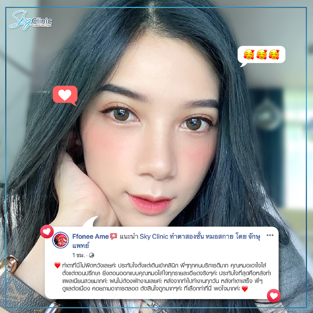 Review of Nong Namfon's experience of getting double eyelid surgery by Dr. Sky