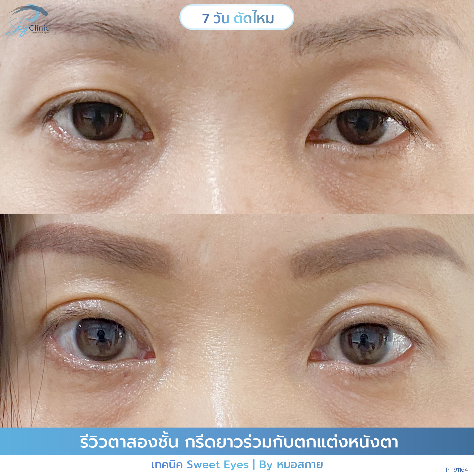 Under-EYe Bags