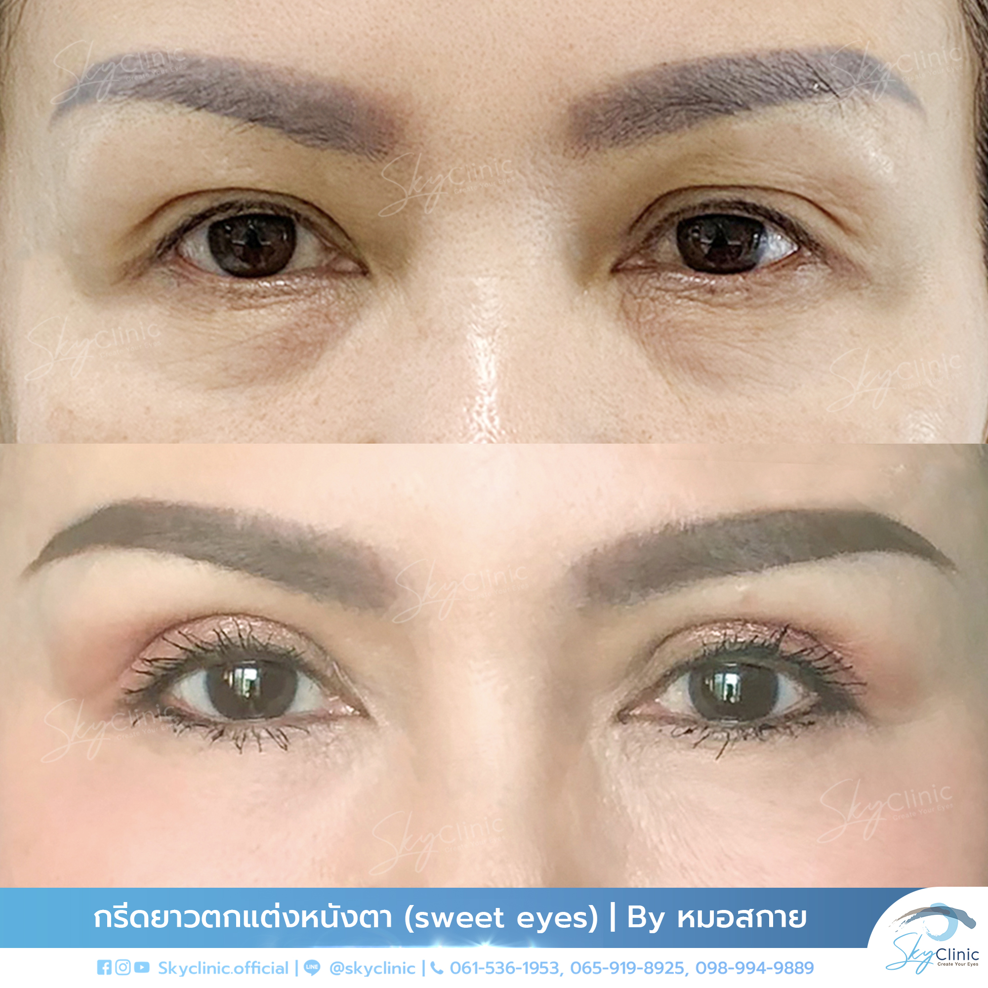 Correction of Drooping Eyelids and Drooping Outer Eye Corners